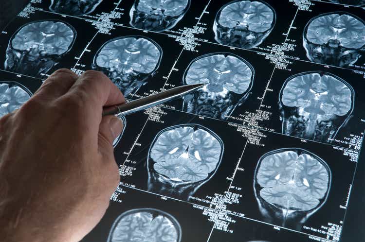 Apollomics Stock Surges 76% After Positive Report on Brain Cancer Therapy 1 MRI Brain Scan of head and skull with hand pointing