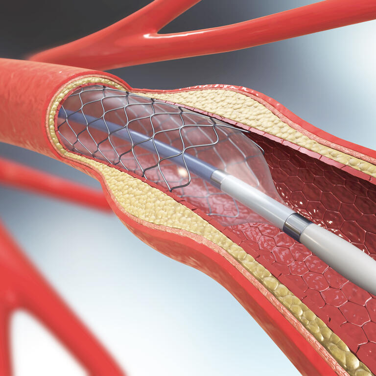 3d illustration of stent implantation for supporting blood circulation into blood vessels