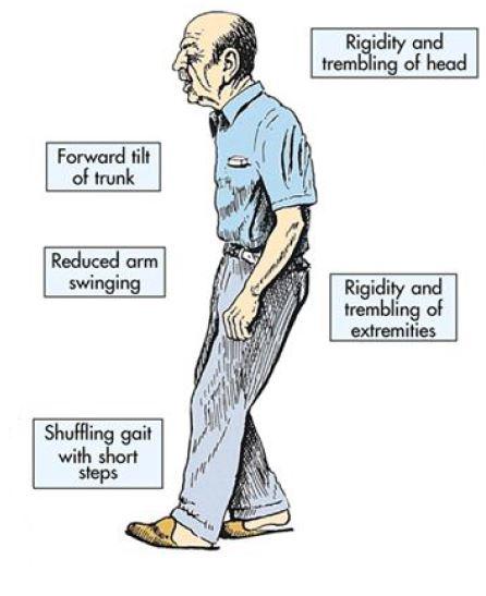 Bradykinesia: What Is It, Causes, Diagnosis, and More