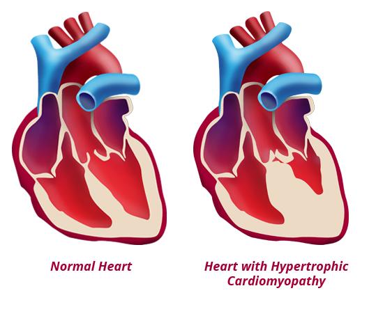 Busy Calendar For Biotech Buy Myokardia (NYSEARCA:LABU) | Seeking Alpha