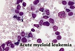 Image result for Acute Myeloid Leukemia