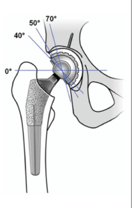 Acetabular Cup Abduction Angle