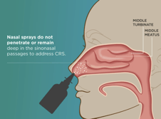 Lyra Therapeutics: Advancing An Innovative Solution For Chronic ...