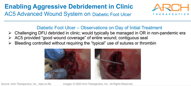 Diabetic foot ulcer pre-treatment