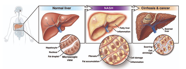 NASH pathology