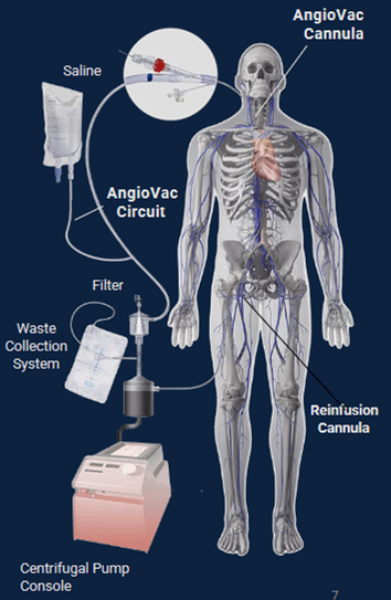 AngioVac thrombectomy system