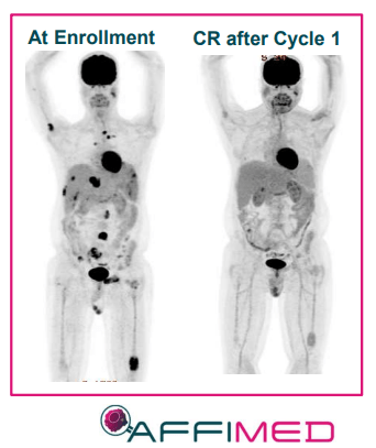 AFM13+NK Cell Combo Complete Response