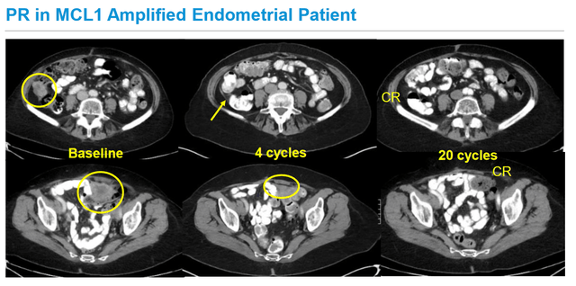 Phase 1 endometrial cancer response