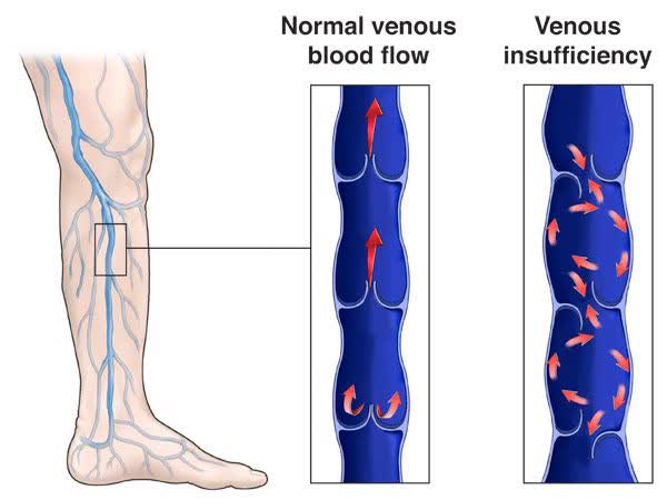 Chronic Venous Insufficiency |  Vascular Treatment in New Jersey