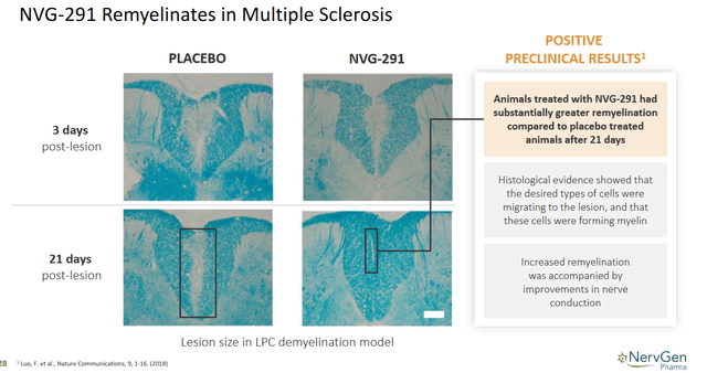 Remyelination slide in MS