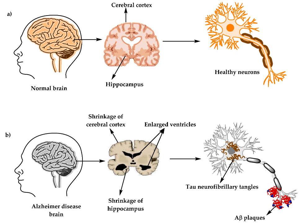 Comprehensive Review on Alzheimer's Disease: Causes and Treatment