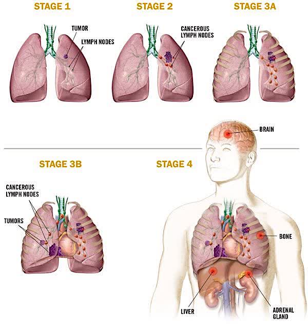 NSCLC