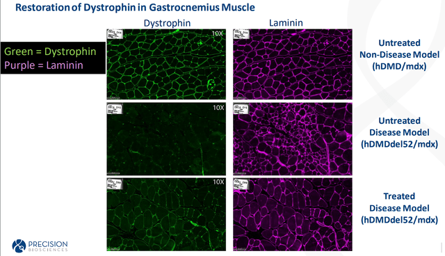 Precision Biosciences ARCUS Dystrophin Restoration