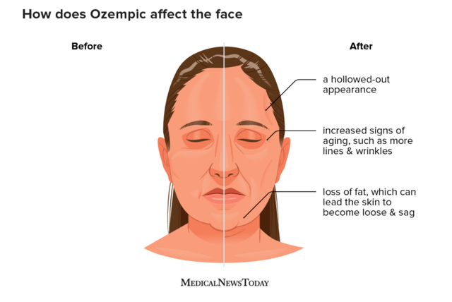 Ozempic face