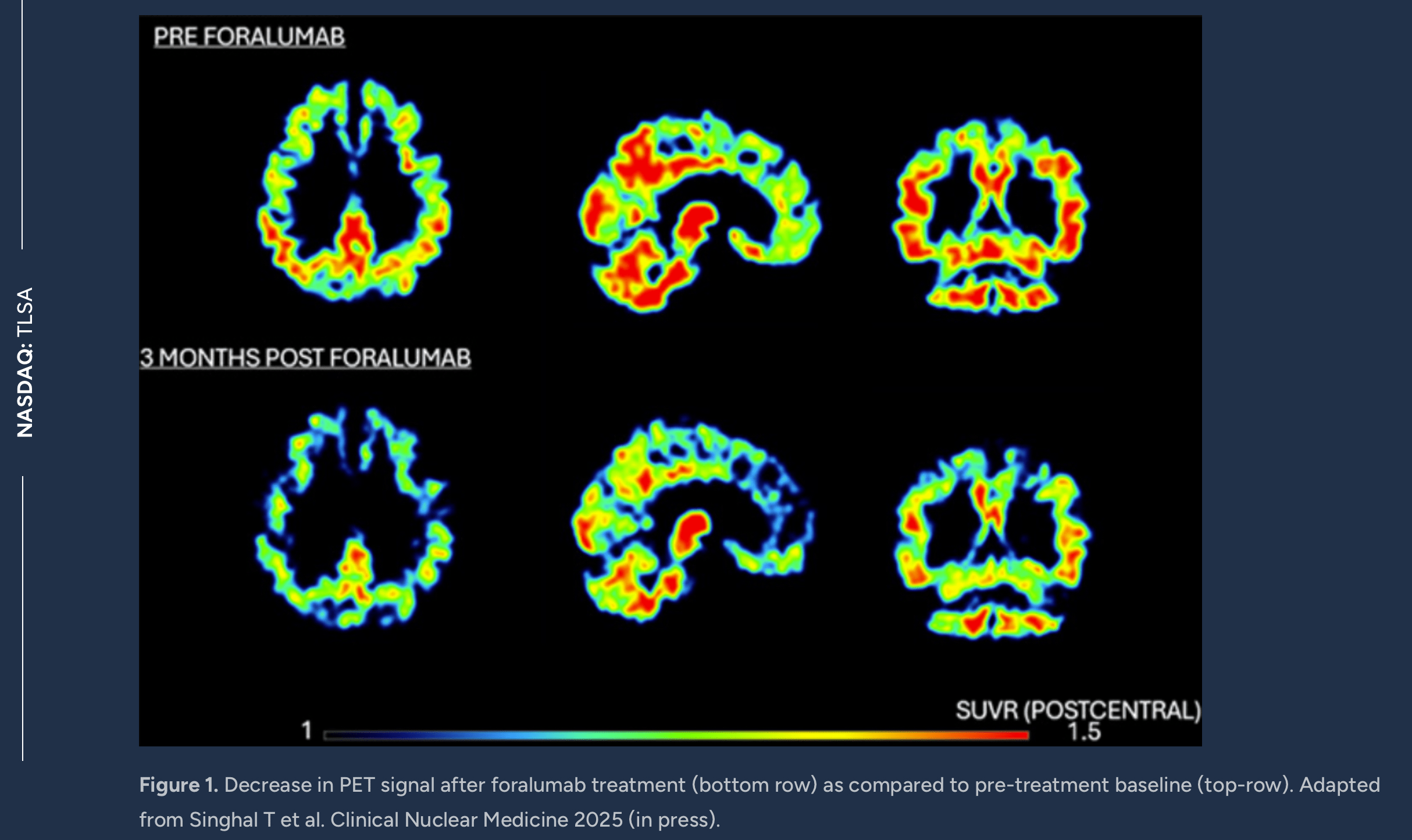 INmune Bio: XPro Trial Readout In Alzheimer's Disease Offers Big  Opportunity (NASDAQ:INMB) | Seeking Alpha