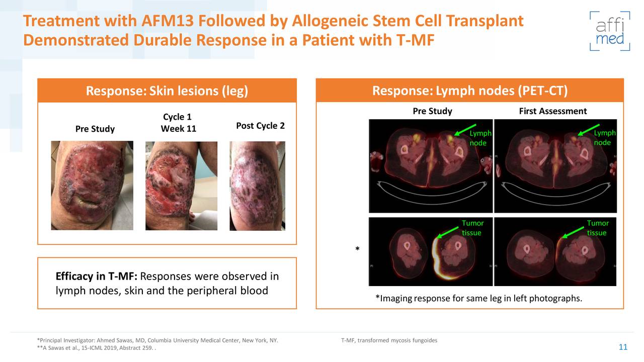 Treatment with AFM13 Followed by Allogeneic Stem Cell Transplant